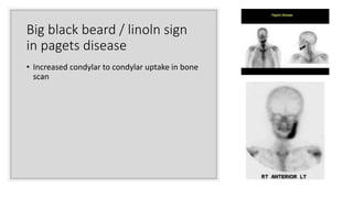 Big black beard / linoln sign
in pagets disease
• Increased condylar to condylar uptake in bone
scan
 
