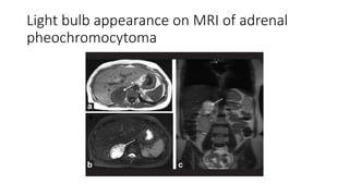 Light bulb appearance on MRI of adrenal
pheochromocytoma
 