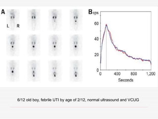 6/12 old boy, febrile UTI by age of 2/12, normal ultrasound and VCUG
 