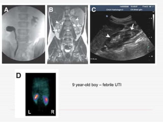 9 year-old boy – febrile UTI
 
