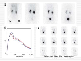 Indirect radionuclide cystography
 
