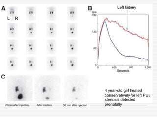 4 year-old girl treated
conservatively for left PUJ
stenosis detected
prenatally
Left kidney
20min after injection After miction 50 min after injection
 