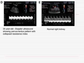 35 year-old : Doppler ultrasound
showing parvus-tardus pattern with
collapsed resistance index
Normal right kidney
 