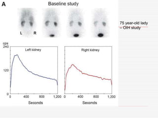 75 year-old lady
– OIH study
 
