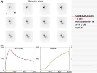 Graft dysfunction
1d post-
transplantation in
a 41 y-old
woman
 
