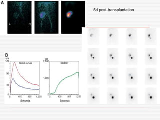 5d post-transplantation
 