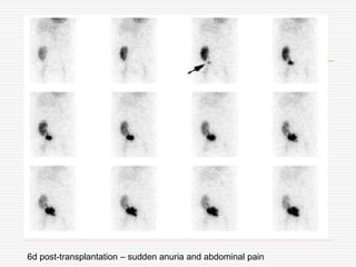 6d post-transplantation – sudden anuria and abdominal pain
 