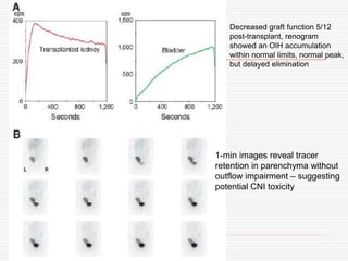 Decreased graft function 5/12
post-transplant, renogram
showed an OIH accumulation
within normal limits, normal peak,
but delayed elimination
1-min images reveal tracer
retention in parenchyma without
outflow impairment – suggesting
potential CNI toxicity
 