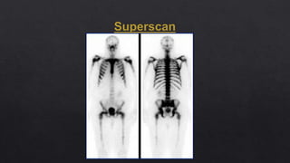 Superscan Bone Nuclear medicine in orthopaedic conditions | PPTX