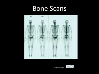 Bone Scans
Image courtesy of
 