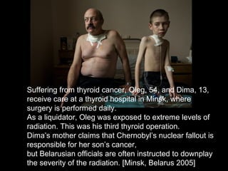 Suffering from thyroid cancer, Oleg, 54, and Dima, 13,
receive care at a thyroid hospital in Minsk, where
surgery is performed daily.
As a liquidator, Oleg was exposed to extreme levels of
radiation. This was his third thyroid operation.
Dima’s mother claims that Chernobyl’s nuclear fallout is
responsible for her son’s cancer,
but Belarusian officials are often instructed to downplay
the severity of the radiation. [Minsk, Belarus 2005]
 