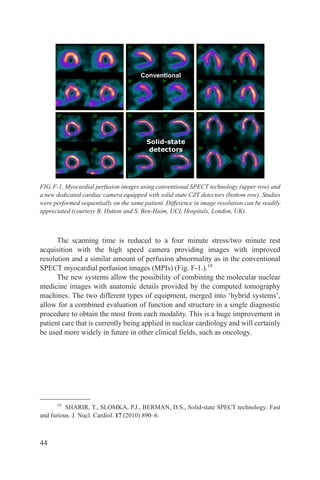 Conventional




                                         Solid-state
                                          detectors




FIG. F-1. Myocardial perfusion images using conventional SPECT technology (upper row) and
a new dedicated cardiac camera equipped with solid state CZT detectors (bottom row). Studies
were performed sequentially on the same patient. Difference in image resolution can be readily
appreciated (courtesy B. Hutton and S. Ben-Haim, UCL Hospitals, London, UK).



      The scanning time is reduced to a four minute stress/two minute rest
acquisition with the high speed camera providing images with improved
resolution and a similar amount of perfusion abnormality as in the conventional
SPECT myocardial perfusion images (MPIs) (Fig. F-1.).19
      The new systems allow the possibility of combining the molecular nuclear
medicine images with anatomic details provided by the computed tomography
machines. The two different types of equipment, merged into ‘hybrid systems’,
allow for a combined evaluation of function and structure in a single diagnostic
procedure to obtain the most from each modality. This is a huge improvement in
patient care that is currently being applied in nuclear cardiology and will certainly
be used more widely in future in other clinical fields, such as oncology.




      19
          SHARIR, T., SLOMKA, P.J., BERMAN, D.S., Solid-state SPECT technology: Fast
and furious. J. Nucl. Cardiol. 17 (2010) 890–6.



44
 