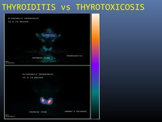 THYROIDITIS vs THYROTOXICOSIS
 