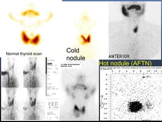 Hot nodule (AFTN)
Cold
nodule
Normal thyroid scan
 