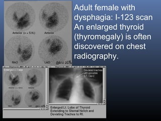 Adult female with
dysphagia: I-123 scan
An enlarged thyroid
(thyromegaly) is often
discovered on chest
radiography.
 