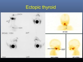 Ectopic thyroid
 