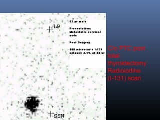C/o PTC post
total
thyroidectomy
Radioiodine
(I-131) scan
 