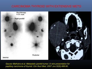 CARCINOMA THYROID WITH EXTENSIVE METS
Gaurav Malhotra et.al. Metastatic parotid tumor: A rare presentation for
papillary carcinoma of thyroid. Clin Nucl Med. 2007 Jun;32(6):488-90.
 