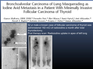 52 yr male a known case of follicular carcinoma of thyroid was
administered 182 mCi of radioiodine a month after total
thyroidectomy.
Post therapy scan: Radioiodine uptake in apex of left lung
 