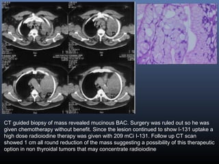 CT guided biopsy of mass revealed mucinous BAC. Surgery was ruled out so he was
given chemotherapy without benefit. Since the lesion continued to show I-131 uptake a
high dose radioiodine therapy was given with 209 mCi I-131. Follow up CT scan
showed 1 cm all round reduction of the mass suggesting a possibility of this therapeutic
option in non thyroidal tumors that may concentrate radioiodine
 