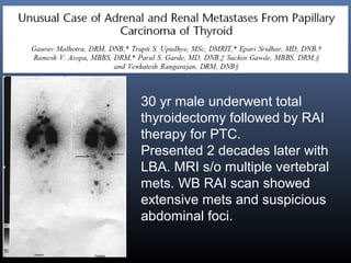 30 yr male underwent total
thyroidectomy followed by RAI
therapy for PTC.
Presented 2 decades later with
LBA. MRI s/o multiple vertebral
mets. WB RAI scan showed
extensive mets and suspicious
abdominal foci.
 