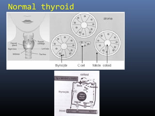 Normal thyroid
 