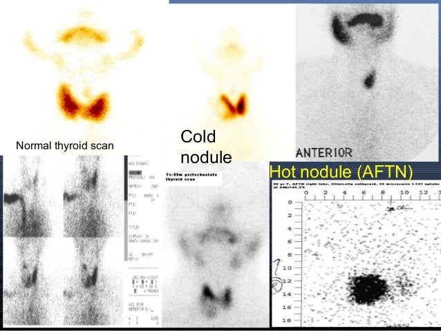 Nuclear Medicine in Thyroidology
