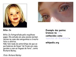 Billie-Jo                                 Exemplo dos pontos
                                          brancos na íris,
Billie Jo fotografada pelo orgulhoso
                                          conhecidos como
papai. Ela estuda em uma escola normal,
dorme na casa dos amiguinhos e é muito    manchas de Brushfield-
feliz e afetiva.
                                          wikipedia.org
Não tem nada do esteriótipo de que os
portadores de Down "só ficam em casa,
gordos e com as línguas de fora", conta
Richard Bailey.

Foto: Richard Bailey
 