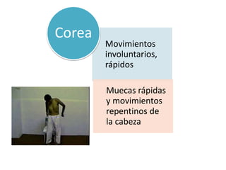Movimientos
involuntarios,
rápidos
Muecas rápidas
y movimientos
repentinos de
la cabeza
Corea
 