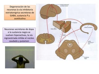 Degeneración de las
neuronas la vía inhibitoria
estriatonigrica secretoras de
GABA, sustancia P y
acetilcolina
Neuronas secretoras de dopa
e la sustancia negra se
vuelven hiperactivas, la vía
nigroestriada inhibe el núcleo
caudado y putamen
 
