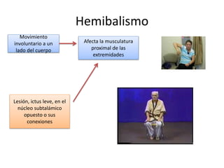 Hemibalismo
Movimiento
involuntario a un
lado del cuerpo
Afecta la musculatura
proximal de las
extremidades
Lesión, ictus leve, en el
núcleo subtalámico
opuesto o sus
conexiones
 