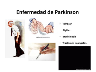 Enfermedad de Parkinson
• Temblor
• Rigidez
• Bradicinesia
• Trastornos posturales.
 