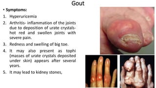 Gout
• Symptoms:
1. Hyperuricemia
2. Arthritis- inflammation of the joints
due to deposition of urate crystals-
hot red and swollen joints with
severe pain.
3. Redness and swelling of big toe.
4. It may also present as tophi
(masses of urate crystals deposited
under skin) appears after several
years.
5. It may lead to kidney stones,
24
 