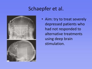 Results and FindingsMost patients reported positive effects instantaneously – they had newfound motivation.Most patients improved only in the short-term – they had instant results that did not last.Deep brain stimulation of the nucleus accumbens did not treat depression in the long term.