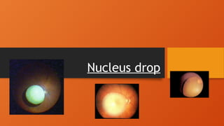 Complications of cataract surgery - nucleus drop | PPTX