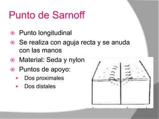 Punto de Sarnoff
 Punto longitudinal
 Se realiza con aguja recta y se anuda
  con las manos
 Material: Seda y nylon
 Puntos de apoyo:
       Dos proximales
       Dos distales
 