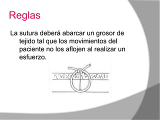 Reglas
La sutura deberá abarcar un grosor de
   tejido tal que los movimientos del
   paciente no los aflojen al realizar un
   esfuerzo.
 