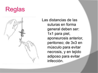 Reglas
         Las distancias de las
            suturas en forma
            general deben ser:
            1x1 para piel,
            aponeurosis anterior,
            peritoneo; de 3x3 en
            músculo para evitar
            necrosis, y en tejido
            adiposo para evitar
            infección.
 