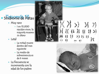 Trisomía 13
 Síndrome de Patau
 Muy raro
 I en 15,000
nacidos vivos, la
mayoría mueren
in útero
 Letal
 La mitad muere
dentro del mes
siguiente
 La medio de
sobrevivencia es
de 6 meses
 La frecuencia se
incrementa con la
edad de los padres
 
