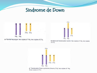 Sindrome de Down
 