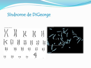 Síndrome de DiGeorge
 