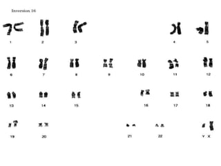 Nuestros cromosomas y sus alteraciones sc2008