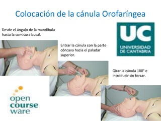 Intubación orotraqueal (IOT)
• Es la mejor técnica para garantizar una adecuada
ventilación y aportación de oxígeno.
• Se ...