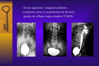   En las siguientes  imágenes podemos  evidenciar como se manifiestan los diversos   grados de reflujos según estudio CUMGS. 