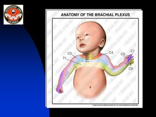 Plexo Braquial 