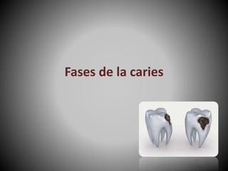 Fases de la caries
 