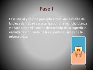 Fase I
• Fase inicial y solo se presenta a nivel del esmalte de
la pieza dental, se caracteriza por una mancha blanca
y opaca sobre el esmalte destacando de la superficie
esmaltada y brillante de las superficies sanas de la
misma pieza.
 