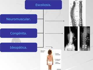 Escoliosis. Neuromuscular. Congénita. Ideopática. 