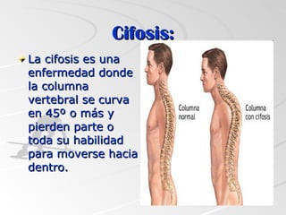 Cifosis: La cifosis es una enfermedad donde la columna vertebral se curva en 45º o más y pierden parte o toda su habilidad para moverse hacia dentro.  
