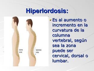 Hiperlordosis: Es al aumento o incremento en la curvatura de la columna vertebral, según sea la zona puede ser cervical, dorsal o lumbar. 